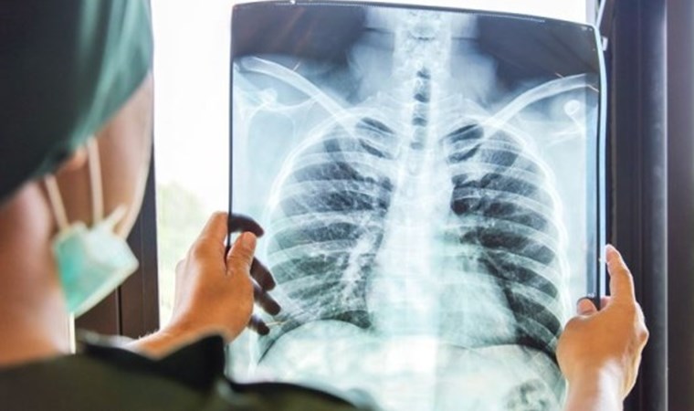 en bulasici hastaliklardan biri her yil 10 milyondan fazla insan yakalaniyor 0 mfTVskKT