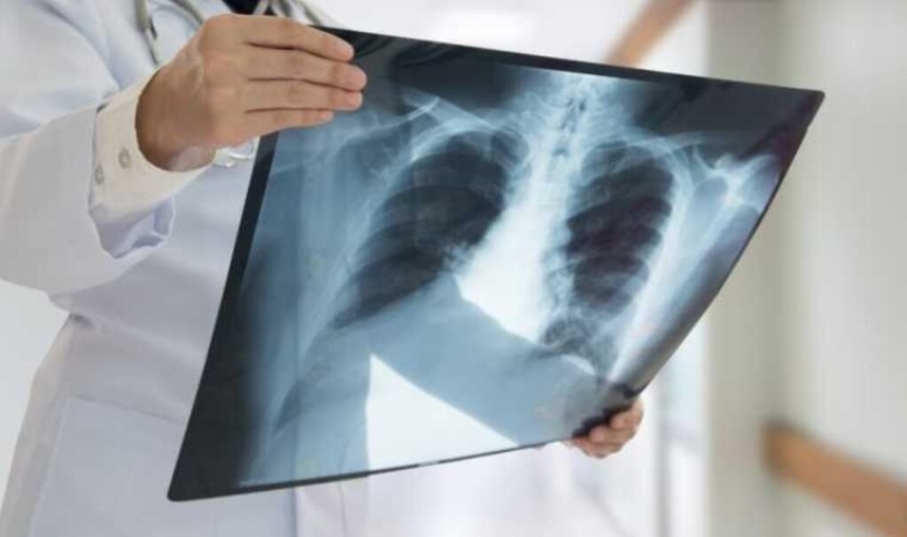 Verem hastalığında erken tanı hayat kurtarır: Tedavi edilmediğinde ölümcül olabilir! 3 verem hastaliginda erken tani hayat kurtarir tedavi edilmediginde olumcul olabilir jXwO3KK6