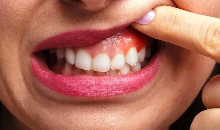 agiz kokusuna neden oluyor bagisiklik sistemini gucsuzlestiriyor dis taslarinin sebep olabilecegi 5 hastalik 0 2INguvTP