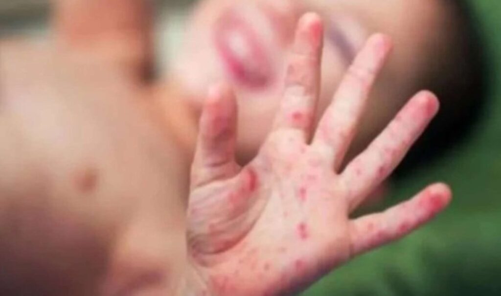 Kızamık vakalarında artış: Aşı olmayanlar risk altında! 8 kizamik vakalarinda artis asi olmayanlar risk altinda kWClxQ3m