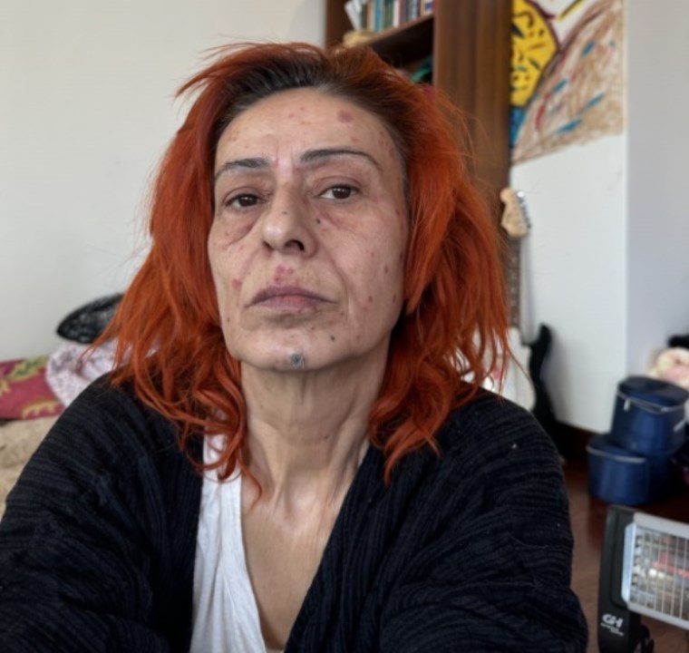 son hali korkuttu yildiz tilbenin yuzu yandi 1