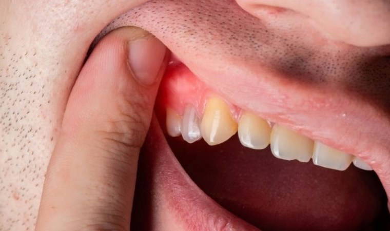 Diş eti hastalıkları kalp sağlığını nasıl tehdit ediyor? 4 dis eti hastaliklari kalp sagligini nasil tehdit ediyor ySEdBXkI
