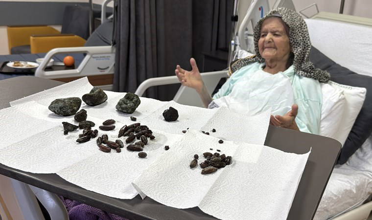Doktorları bile şoke eden ameliyat: Zonguldak'ta 92 yaşındaki kadının midesinden 28 hurma, 35 zeytin çekirdeği ve 5 taş çıkarıldı 1 doktorlari bile soke eden ameliyat zonguldakta 92 yasindaki kadinin midesinden 28 hurma 35 zeytin VzD3OSSa