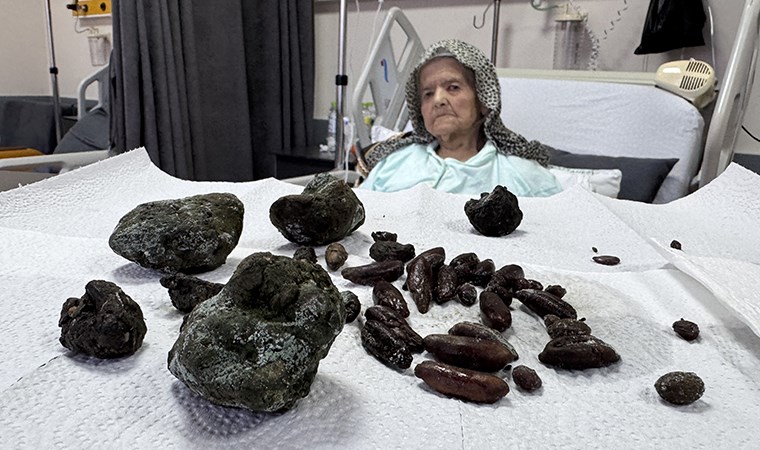 doktorlari bile soke eden ameliyat zonguldakta 92 yasindaki kadinin midesinden 28 hurma 35 zeytin YPeHcNXQ