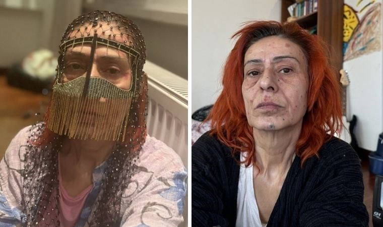Yüzü yanmıştı: Yıldız Tilbe’den maskeli poz!